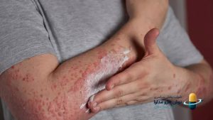 پسوریازیس چیست؟ علائم، علل و راهکارهای جامع مدیریت و درمان